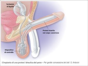 La técnica es mínimamente invasiva y en cuatro a seis semanas el paciente recupera su vida sexual.