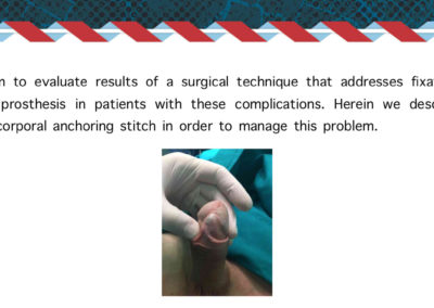 Procedure protesi peniena⚕️Gabriele Antonini MD PhD - Uro-Andrological mini Invasive Surgery - Medical office: Rome, 00185 - Via Niccolò Machiavelli 47 – Phone (+39) 06 64821375