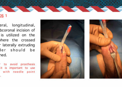 Procedure protesi peniena⚕️Gabriele Antonini MD PhD - Uro-Andrological mini Invasive Surgery - Medical office: Rome, 00185 - Via Niccolò Machiavelli 47 – Phone (+39) 06 64821375