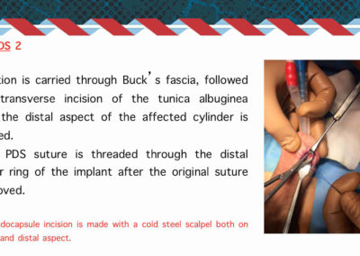 Procedure protesi peniena⚕️Gabriele Antonini MD PhD - Uro-Andrological mini Invasive Surgery - Medical office: Rome, 00185 - Via Niccolò Machiavelli 47 – Phone (+39) 06 64821375