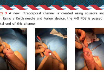 Procedure protesi peniena⚕️Gabriele Antonini MD PhD - Uro-Andrological mini Invasive Surgery - Medical office: Rome, 00185 - Via Niccolò Machiavelli 47 – Phone (+39) 06 64821375