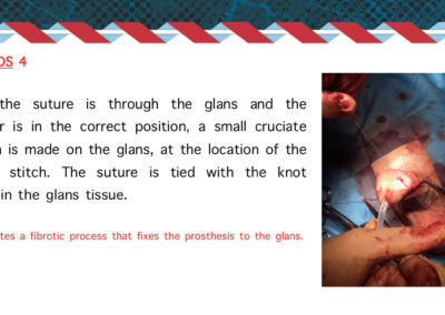 Procedure protesi peniena⚕️Gabriele Antonini MD PhD - Uro-Andrological mini Invasive Surgery - Medical office: Rome, 00185 - Via Niccolò Machiavelli 47 – Phone (+39) 06 64821375