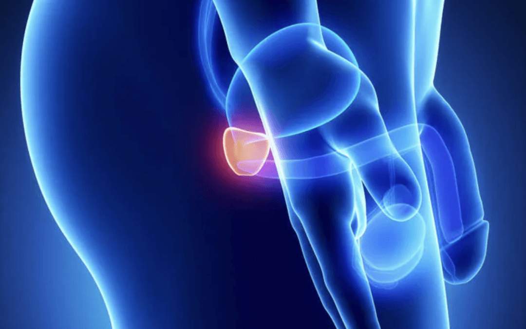 Ruolo e coinvolgimento della dieta nel rischio e nella progressione del cancro alla prostata.