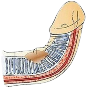 peyronie