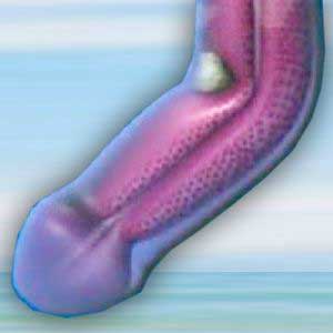 raddrizzamento-del-pene-antoniniurology-2021